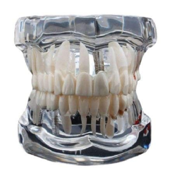 Dental Implant Transparent Model - Generic